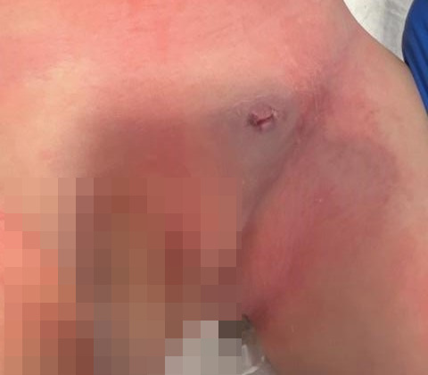 Figura 2. El paciente presenta una buena evolución tras la intervención quirúrgica, con resolución del absceso esplénico